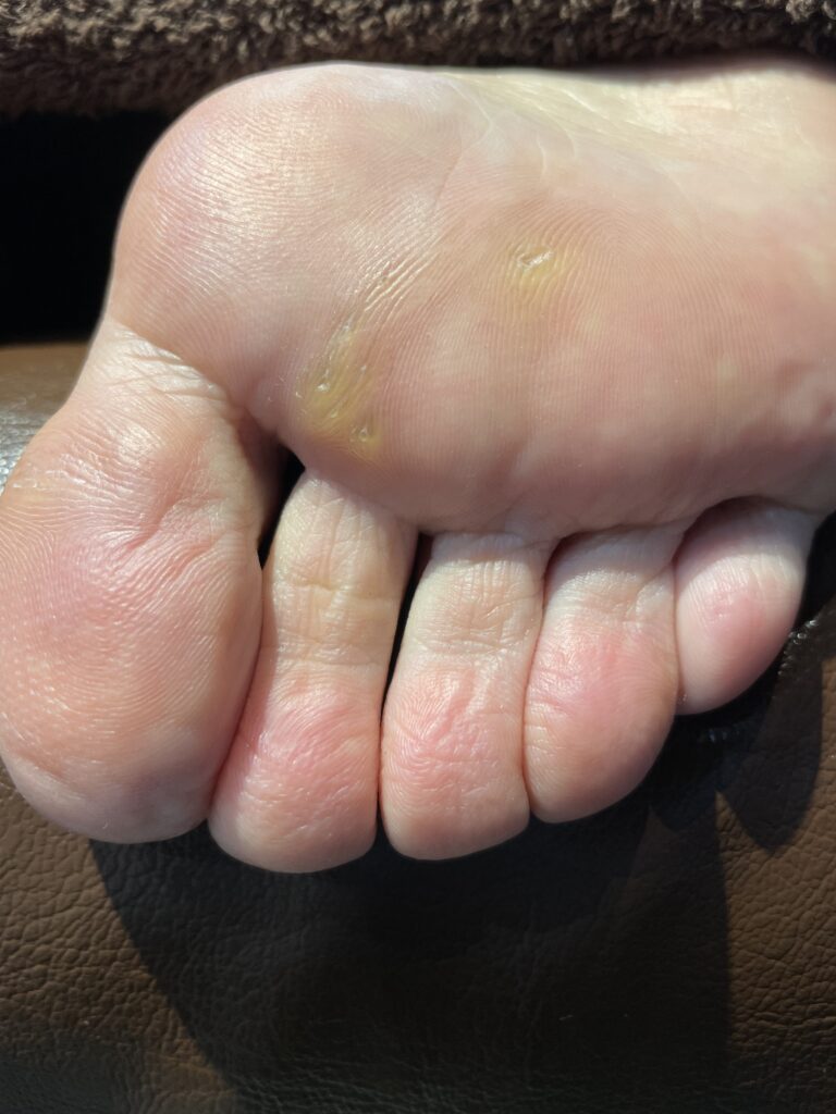 タコや魚の目でお悩みの方向けのフットケア説明用画像